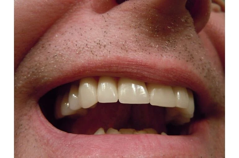 歯周病の治療は保険適用される？